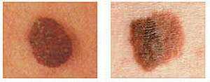 Как выглядит меланома кожи