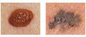 Как выглядит меланома кожи, фото начальная стадия