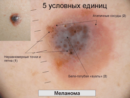 Меланома 4 стадии