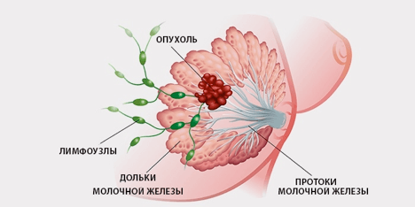 Рак молочной железы 1 стадия