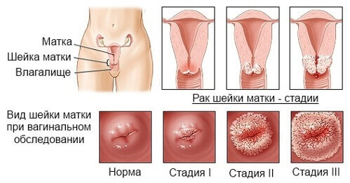 Рак шейки матки 1 стадия: лечение