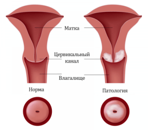 Рак шейки матки стадия 2б, симптомы