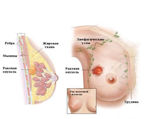 Рак молочной железы: симптомы