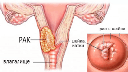 Первые признаки рака шейки матки