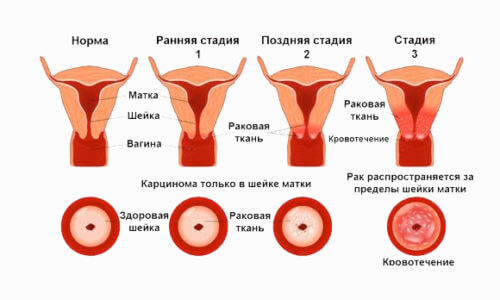 Первые признаки рака матки