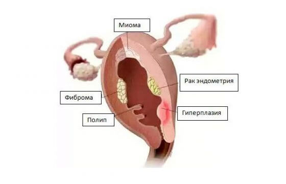 Классификация опухоли матки