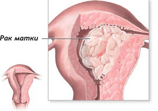 Разновидности рака матки 13