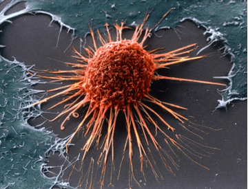 Изображение раковой клетки в матке под микроскопом
