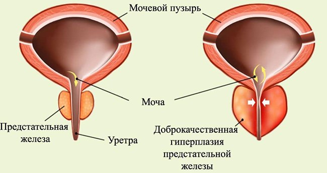 Гиперплазия предстательной железы