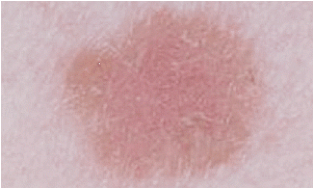 Рак кожи меланома на лице thumbnail