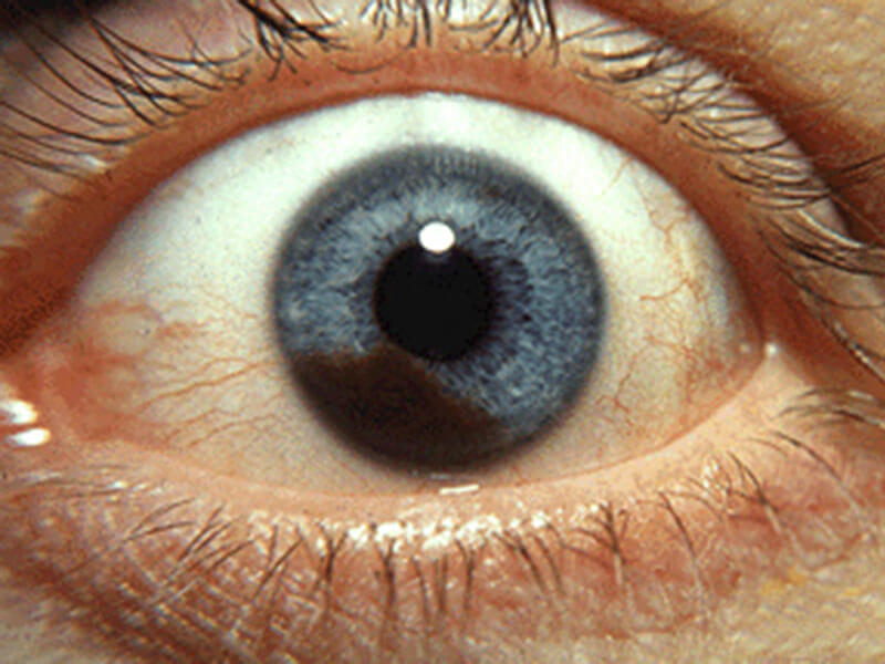 Лечение меланомы хориоидеи глаза народными средствами thumbnail