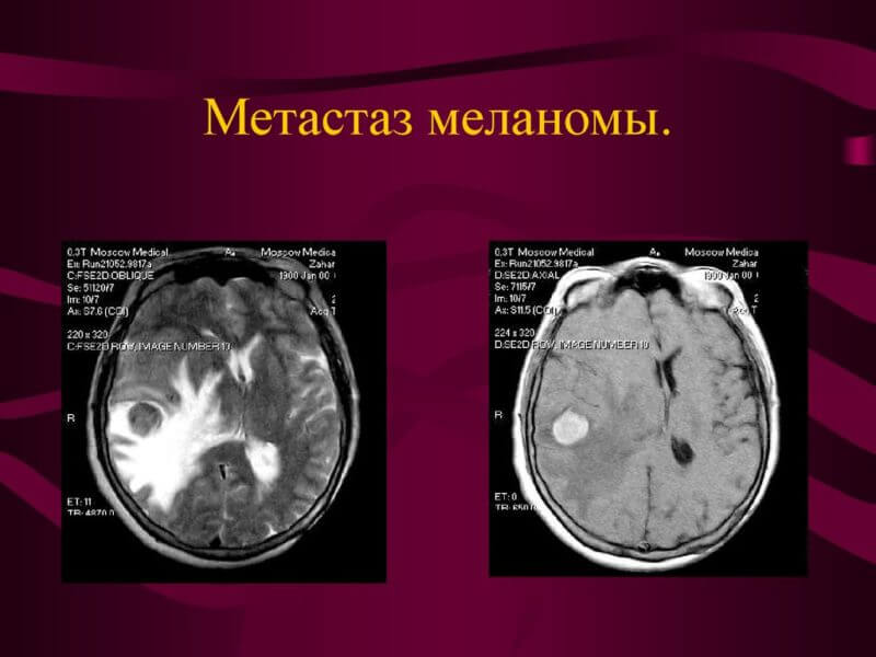 Метастазы меланомы