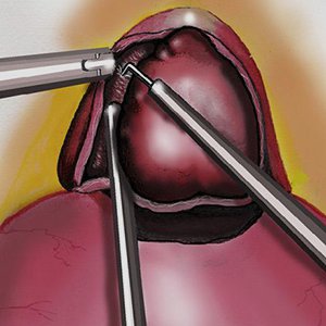 Операция при раке простаты - миниатюра